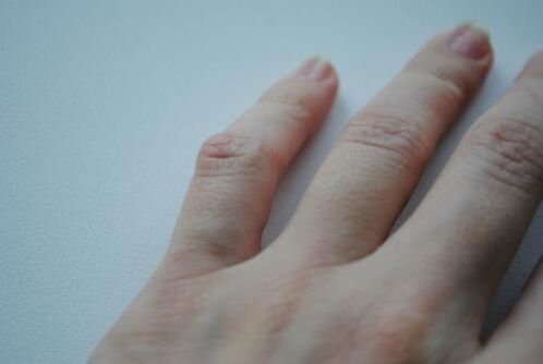 Pe degetul mic a apărut un nodul artritic. 