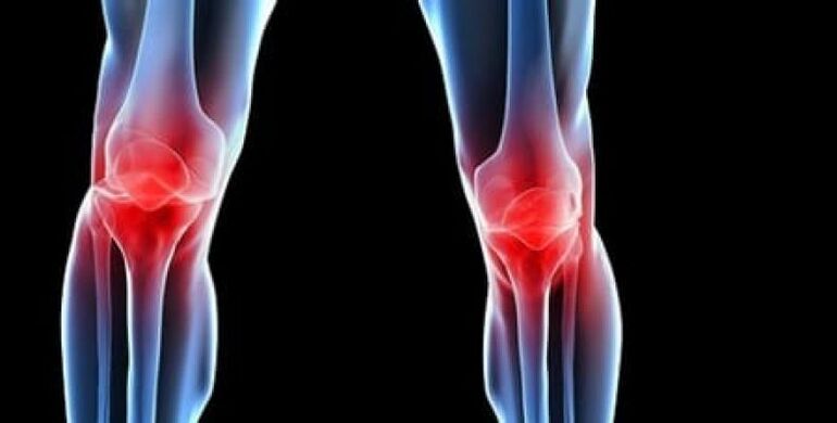 osteoartrita genunchiului