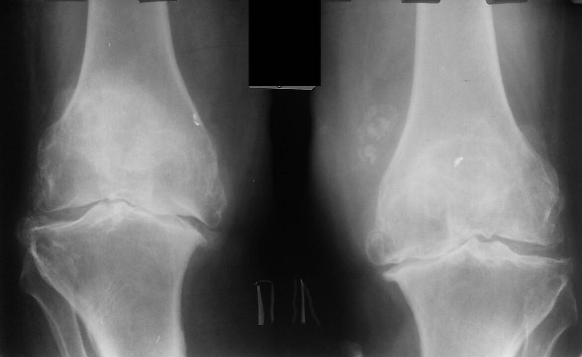 artrita artroza simptomelor soldului unguent pentru a ameliora umflarea articulației genunchiului