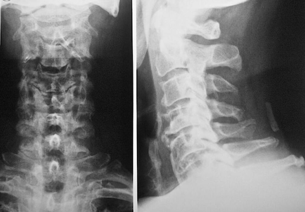 radiografie a coloanei cervicale cu osteocondroză