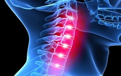 Simptomele osteochondrozei coloanei vertebrale cervicale