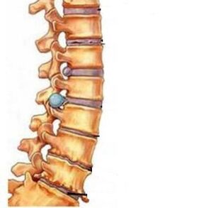 Cum se dezvoltă osteochondroza regiunii cervicale