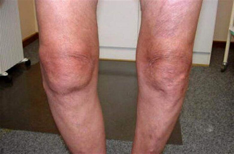 genunchi umflat din cauza artritei