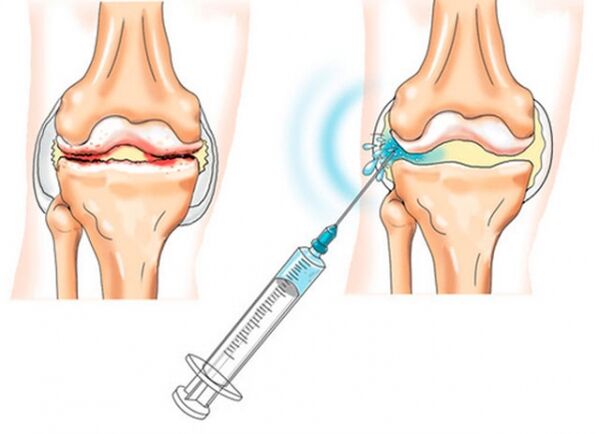 injecții intraarticulare pentru artroza genunchiului