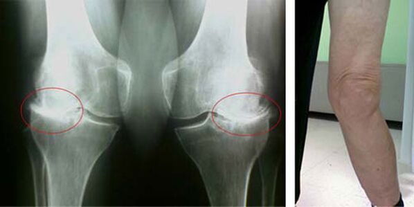 radiografie osteoartrita genunchiului