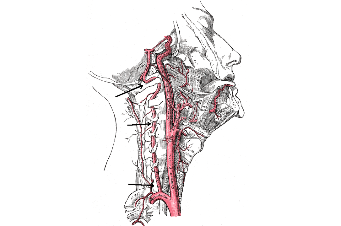 compresia arterei vertebrale cu osteocondroză cervicală