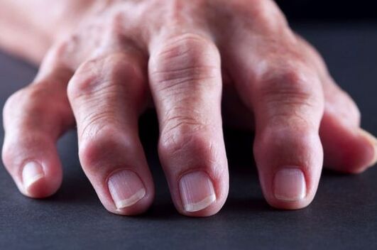 Deformari articulare ale degetelor datorate artrozei sau artritei